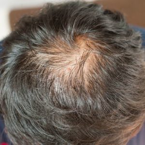 Alopecia Hair Loss, Hair Loss Experts in Lincolnshire