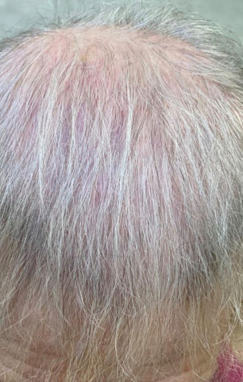 Frequently Asked Questions On Hair Loss and Hair Thinning